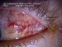 Angular Blepharoconjunctivitis